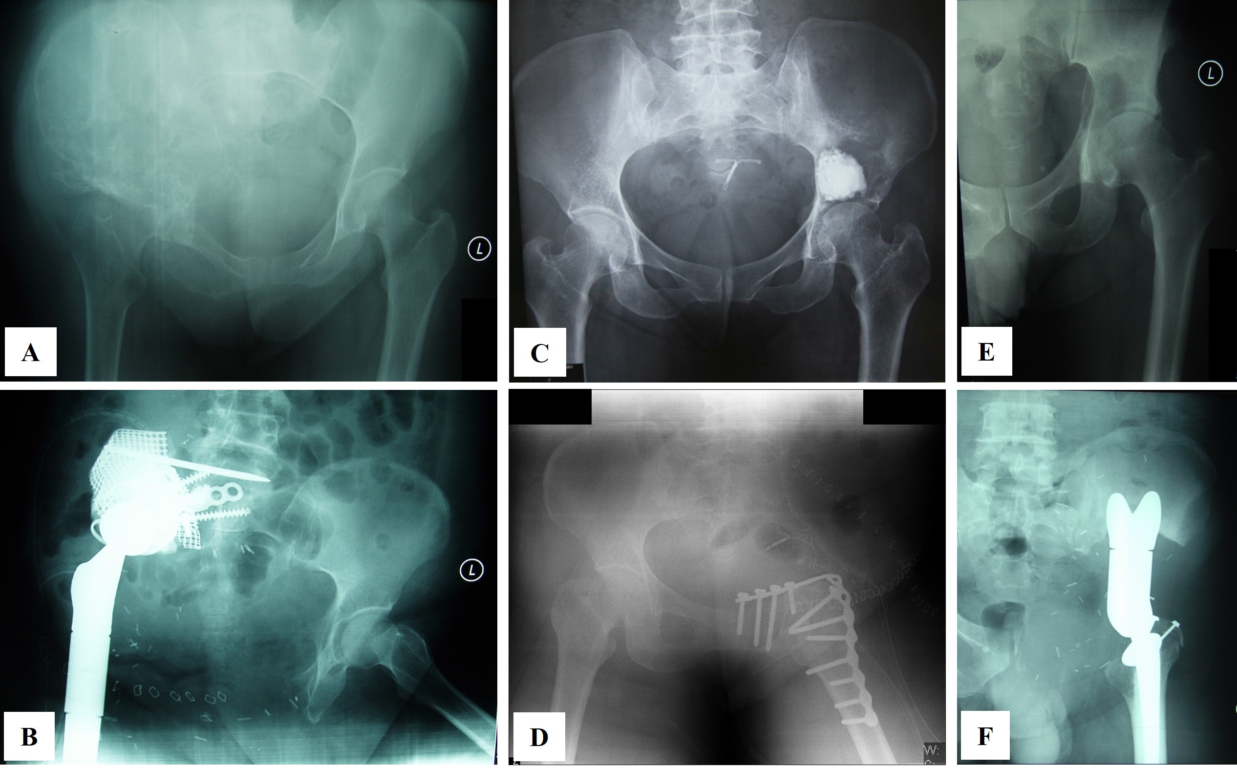 Reconstruction techniques following internal hemipelvectomy for periacetabular chondrosarcoma. Preoperative and postoperative plain radiographs demonstrated three different reconstructive approaches: (A, B) Modified total hip replacement (Case #2), (C, D) hip transposition with fusion (Case #4), and (E, F) saddle endoprosthesis (Case #6)