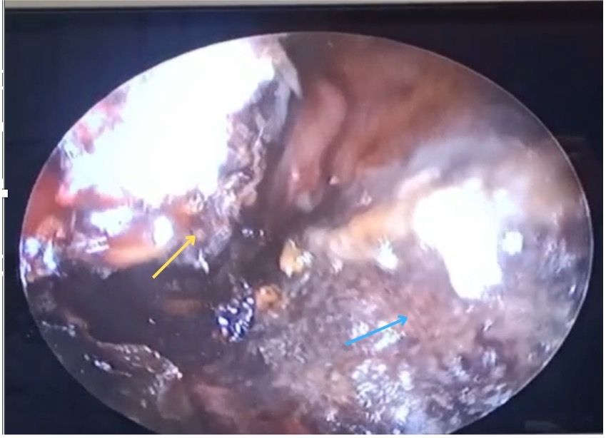 Right nasoendoscopic finding of eschar over the septum (blue arrow) and inferior turbinate (yellow arrow)
