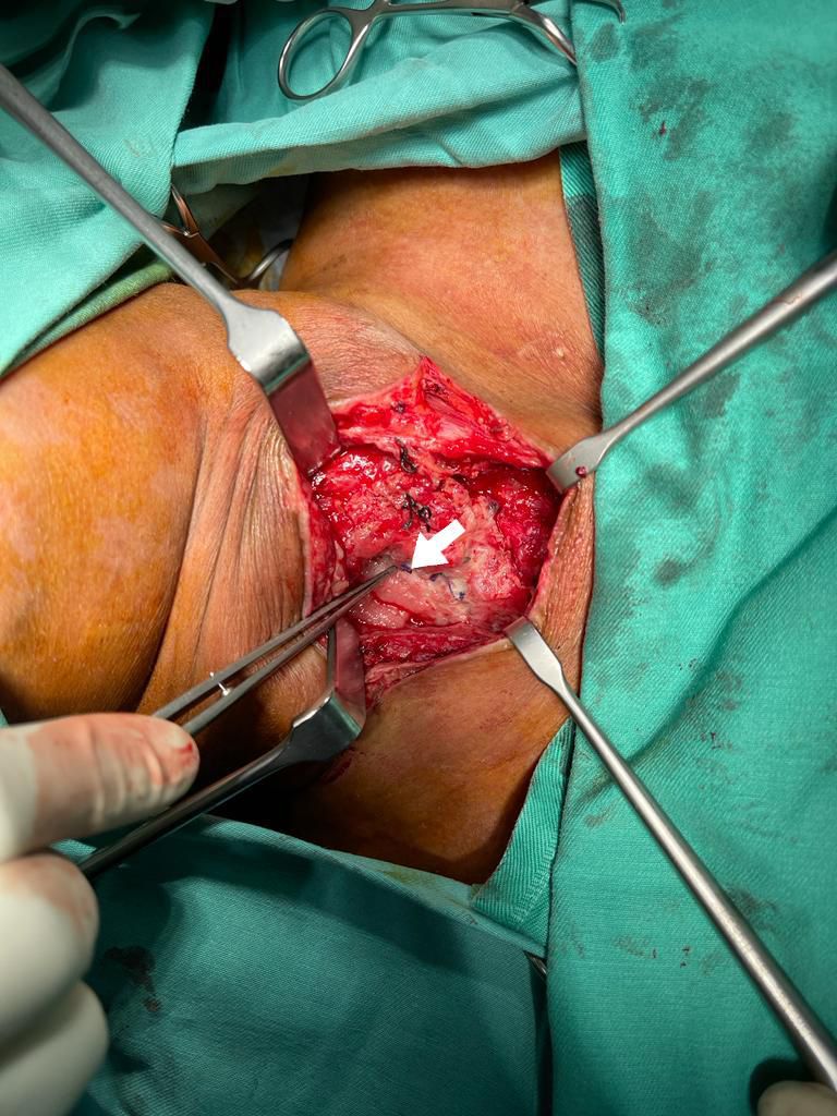 FIGURE 1: Neck re-exploration revealing intact suture at the site of primary repair