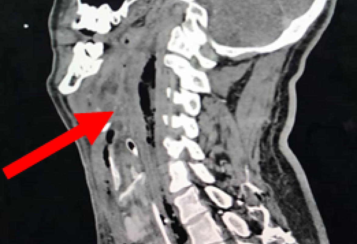 Initial computed tomograpgy neck showed extensive multiloculated gas containing collection seen at retropharyngeal region (red arrow) from the level of oropharynx in sagittal section