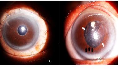 Anterior segment photos showing (A) right eye clear cornea, presence of pseudoexfoliative materials over the pupillary margin, a surgical peripheral iridectomy and a flat conjunctival bleb indicating a failed trabeculectomy, with no sign of vortex keratopathy as compared to (B) whorl-like opacities (white arrows) merging into a horizontal line (black arrows) in the left eye which was very characteristic of vortex keratopathy