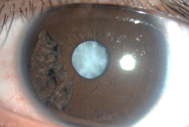 FIGURE 1: Photo of left eye showing sectoral iridoschisis and a dense white cataract