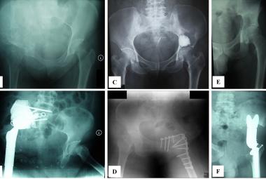 Reconstruction techniques following internal hemipelvectomy for periacetabular chondrosarcoma. Preoperative and postoperative plain radiographs demonstrated three different reconstructive approaches: (A, B) Modified total hip replacement (Case #2), (C, D) hip transposition with fusion (Case #4), and (E, F) saddle endoprosthesis (Case #6)