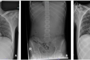 FIGURE 1: (A) Chest radiograph revealed an elevated left hemidiaphragm with absent of gastric bubble; (B) Abdominal radiograph revealed a paucity of small bowel gases that suggest proximal intestinal obstruction; (C) Chest radiograph taken post-intubation revealed bilateral alveolar opacities after the patient aspirated