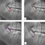 Caries and impacted MTM impaction: (1) Distal caries on MSM; (2) The depth and space of MTM was determined by the Pell & Gregory classification method; (3) The Shiller classification applied in determining the angulation of impacted third molar; (4) The distance between the distal CEJ of the MSM and mesial CEJ of the MTM was calculated as described in Leone classification