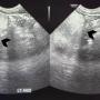 Abdominal ultrasound showed a large lobulated hyperechoic mass occupying abdomen and pelvis (black arrowhead)