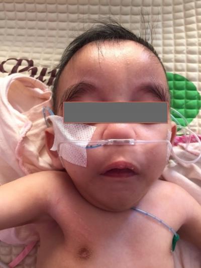 Figure 1: Figure shows clinical apperance of CNPAS such as small chin, widened forehead, low set ears
