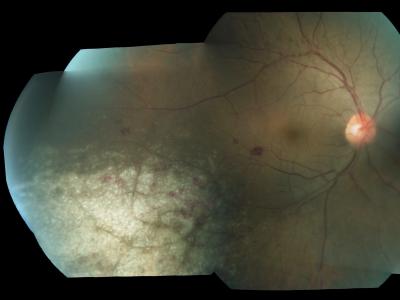 Figure 1: Right fundus examination revealed hemorrhagic retinitis along the inferotemporal vessel and vitreous condensation along superotemporal vessel