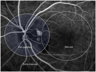 Figure 1: Location of polypoidal lesions on ICG14