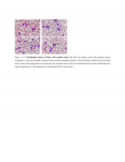 Figure 1: Morphologic features of blasts with cup-like nuclei. The blasts were medium sized with prominent nuclear invagination scanty pale basophilic cytoplasm with occasional azurophilic granules. Some of the blasts exhibited cleaved or bilobed nuclei similar to the hypogranular acute promyelocytic leukaemia, as was shown with arrow (Peripheral blood was stained with Wright stain, original magnification x 400 using Olympus BX-43 microscope)